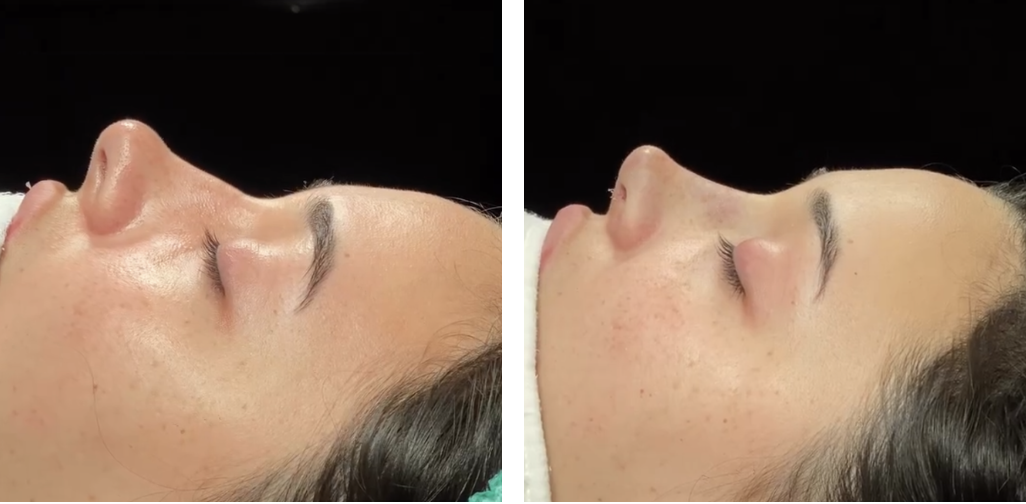 Before and after primary rhinoplasty in Istanbul