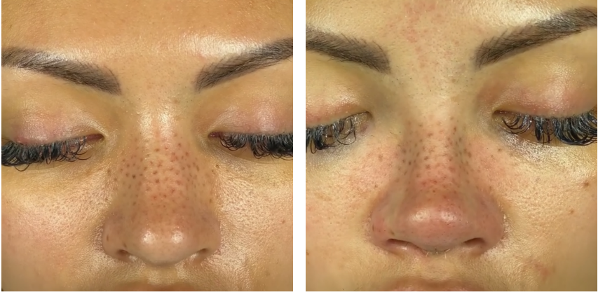 Before and after primary rhinoplasty revision rhinoplasty in Istanbul