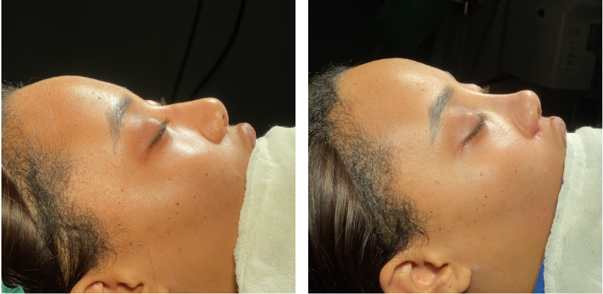 Before and after primary rhinoplasty revision rhinoplasty in Istanbul