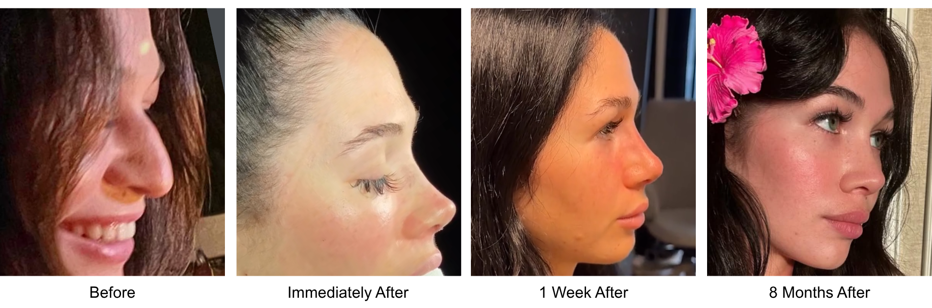 Before and after primary rhinoplasty revision rhinoplasty in Istanbul