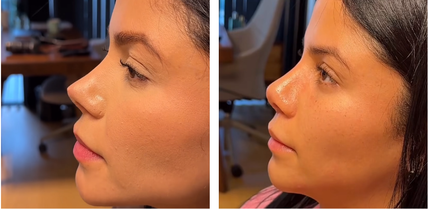 Before and after primary rhinoplasty revision rhinoplasty in Istanbul