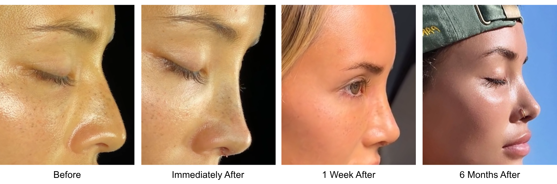 Before and after primary rhinoplasty revision rhinoplasty in Istanbul