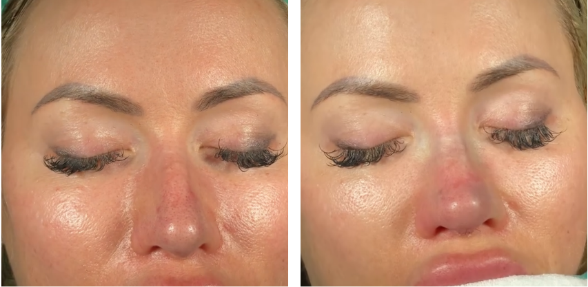 Before and after primary rhinoplasty revision rhinoplasty in Istanbul
