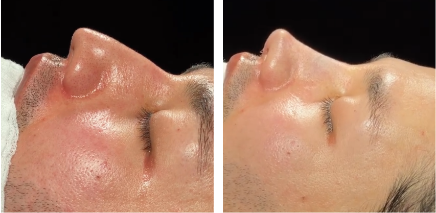 Before and after primary rhinoplasty revision rhinoplasty in Istanbul