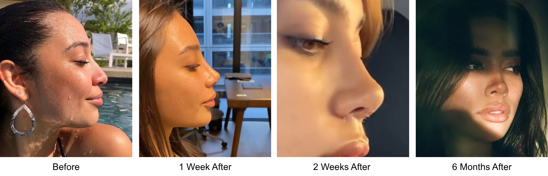 Before and after primary rhinoplasty revision rhinoplasty in Istanbul