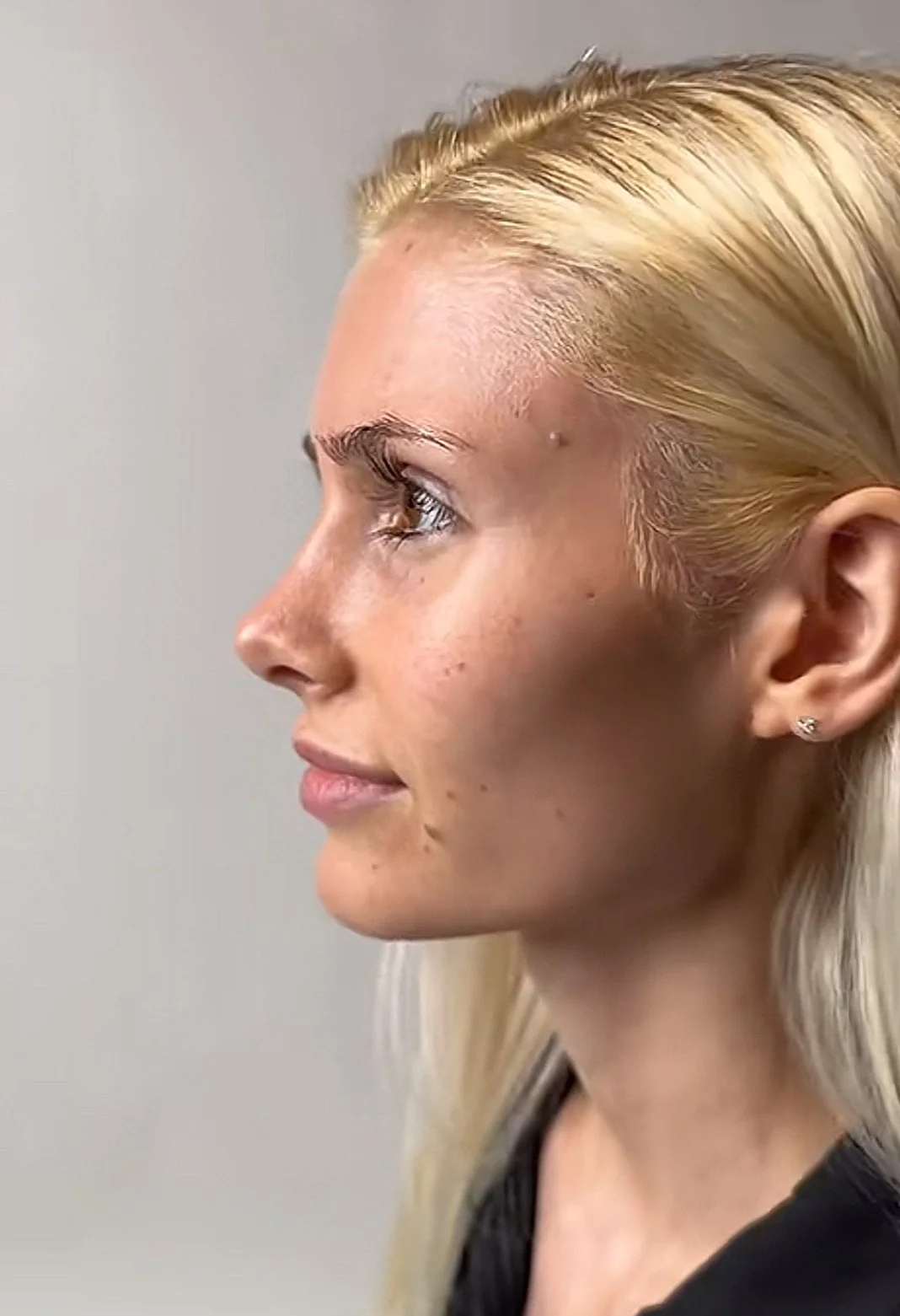 Before and after primary rhinoplasty revision rhinoplasty in Istanbul