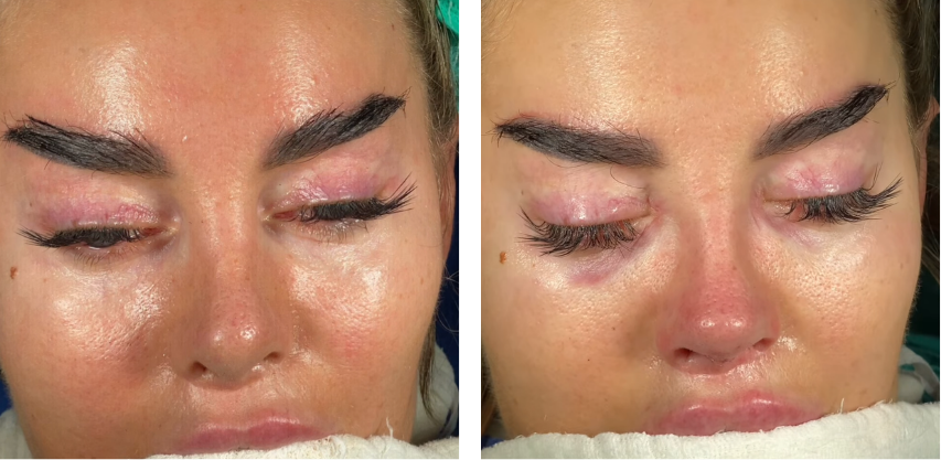 Before and after primary rhinoplasty revision rhinoplasty in Istanbul