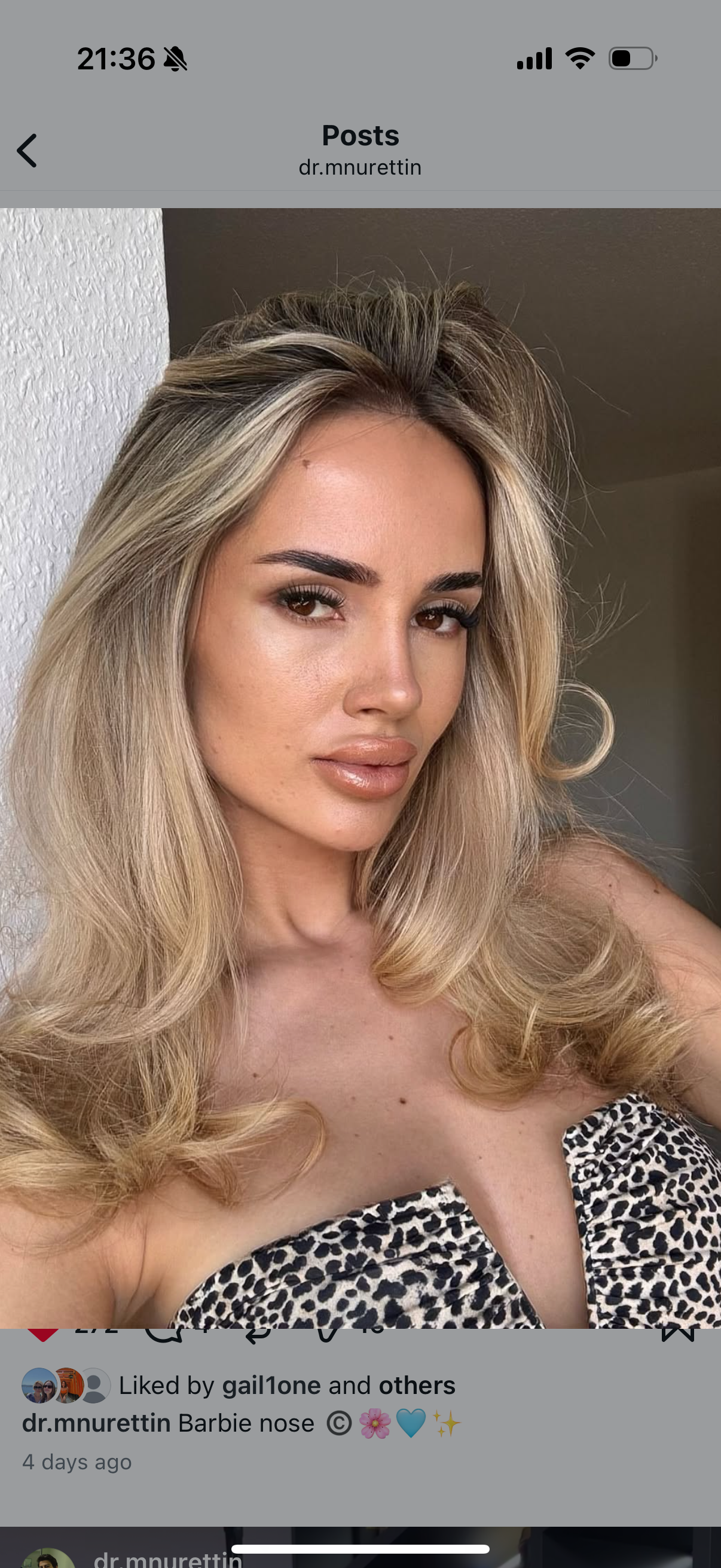 Rhinoplasty recovery timeline