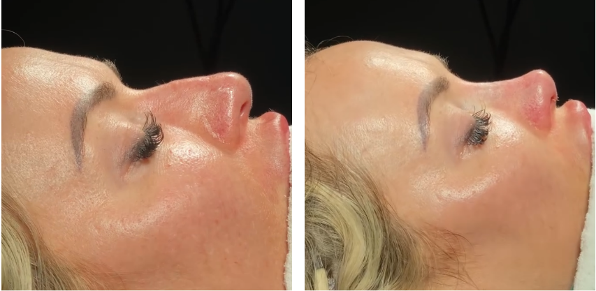 Before and after primary rhinoplasty revision rhinoplasty in Istanbul