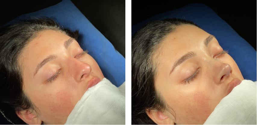 Before and after primary rhinoplasty revision rhinoplasty in Istanbul