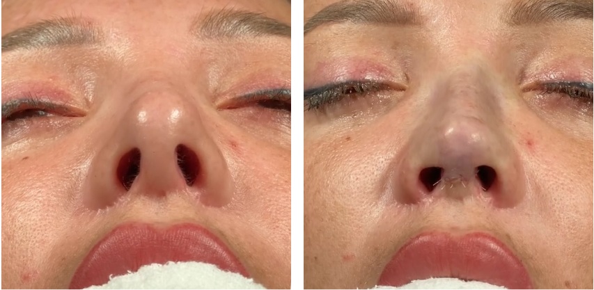 Before and after primary rhinoplasty revision rhinoplasty in Istanbul