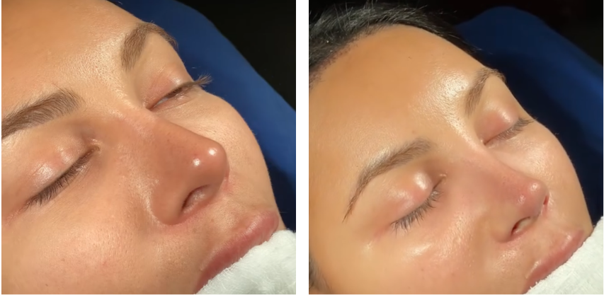 Before and after primary rhinoplasty revision rhinoplasty in Istanbul