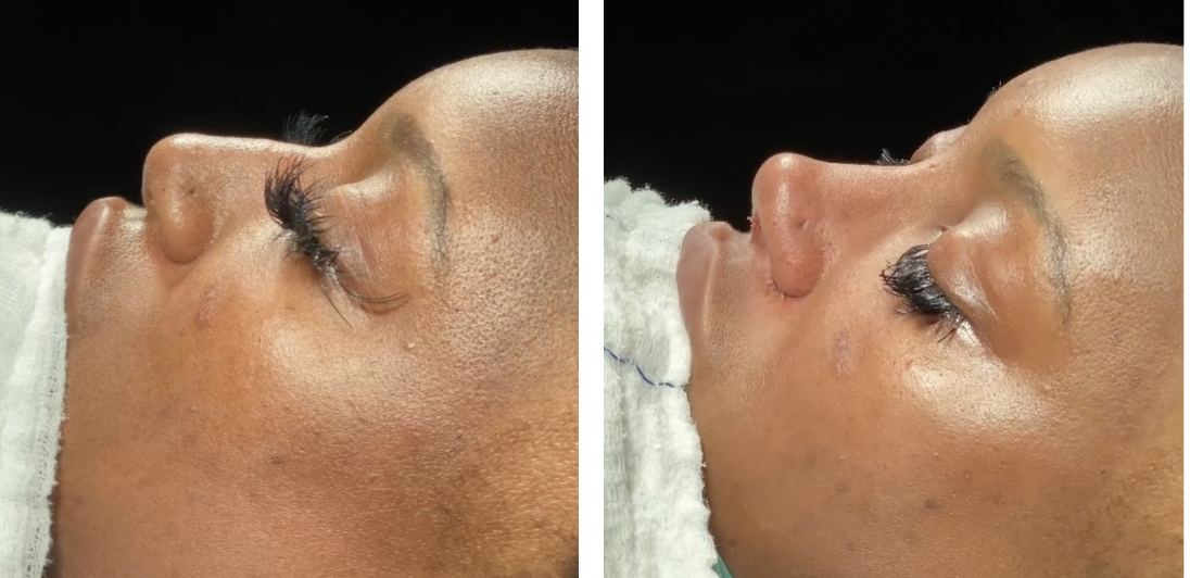 Before and after primary rhinoplasty in Istanbul