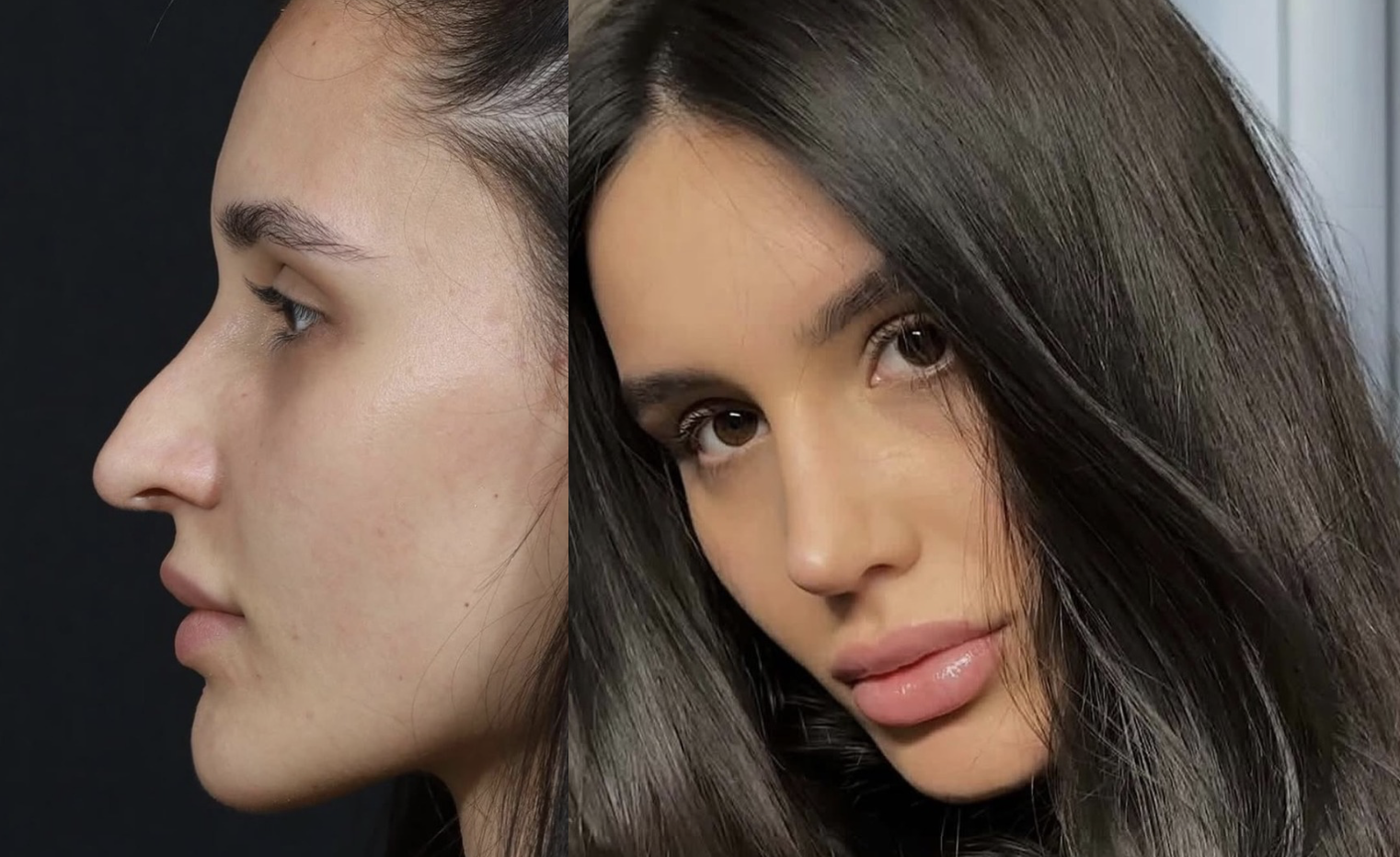 Revision rhinoplasty results in Istanbul