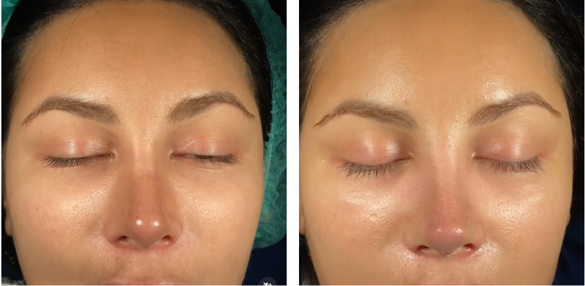 Before and after primary rhinoplasty revision rhinoplasty in Istanbul