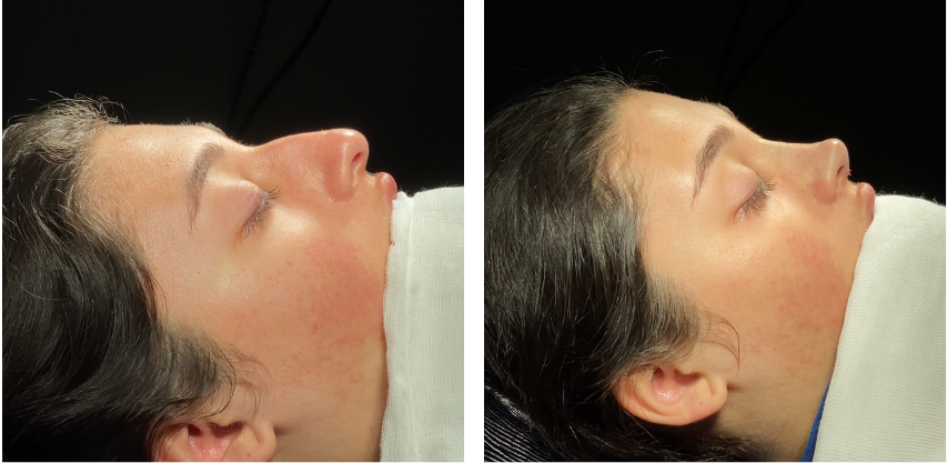 Before and after primary rhinoplasty revision rhinoplasty in Istanbul