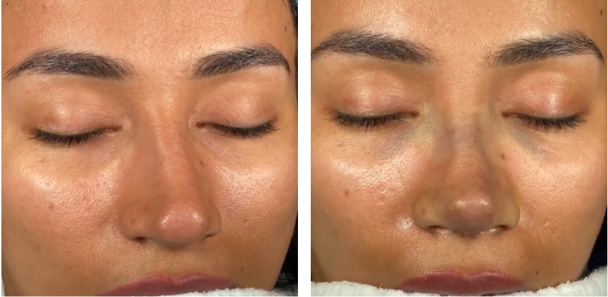 Before and after primary rhinoplasty revision rhinoplasty in Istanbul