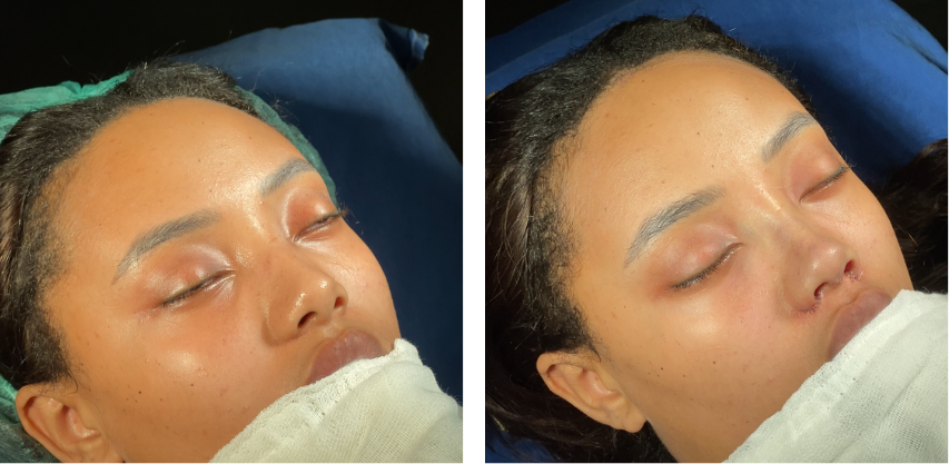Before and after primary rhinoplasty revision rhinoplasty in Istanbul