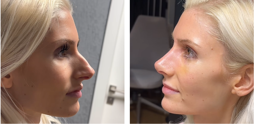 Before and after primary rhinoplasty in Istanbul