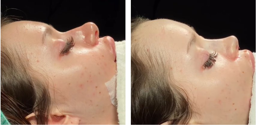 Before and after primary rhinoplasty in Istanbul