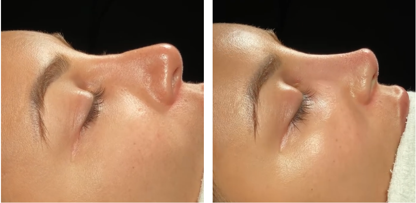 Before and after primary rhinoplasty revision rhinoplasty in Istanbul