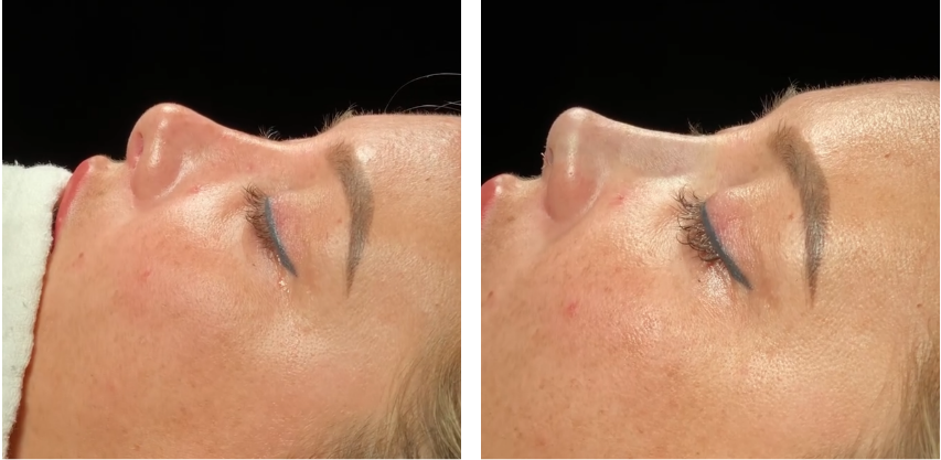 Before and after primary rhinoplasty revision rhinoplasty in Istanbul