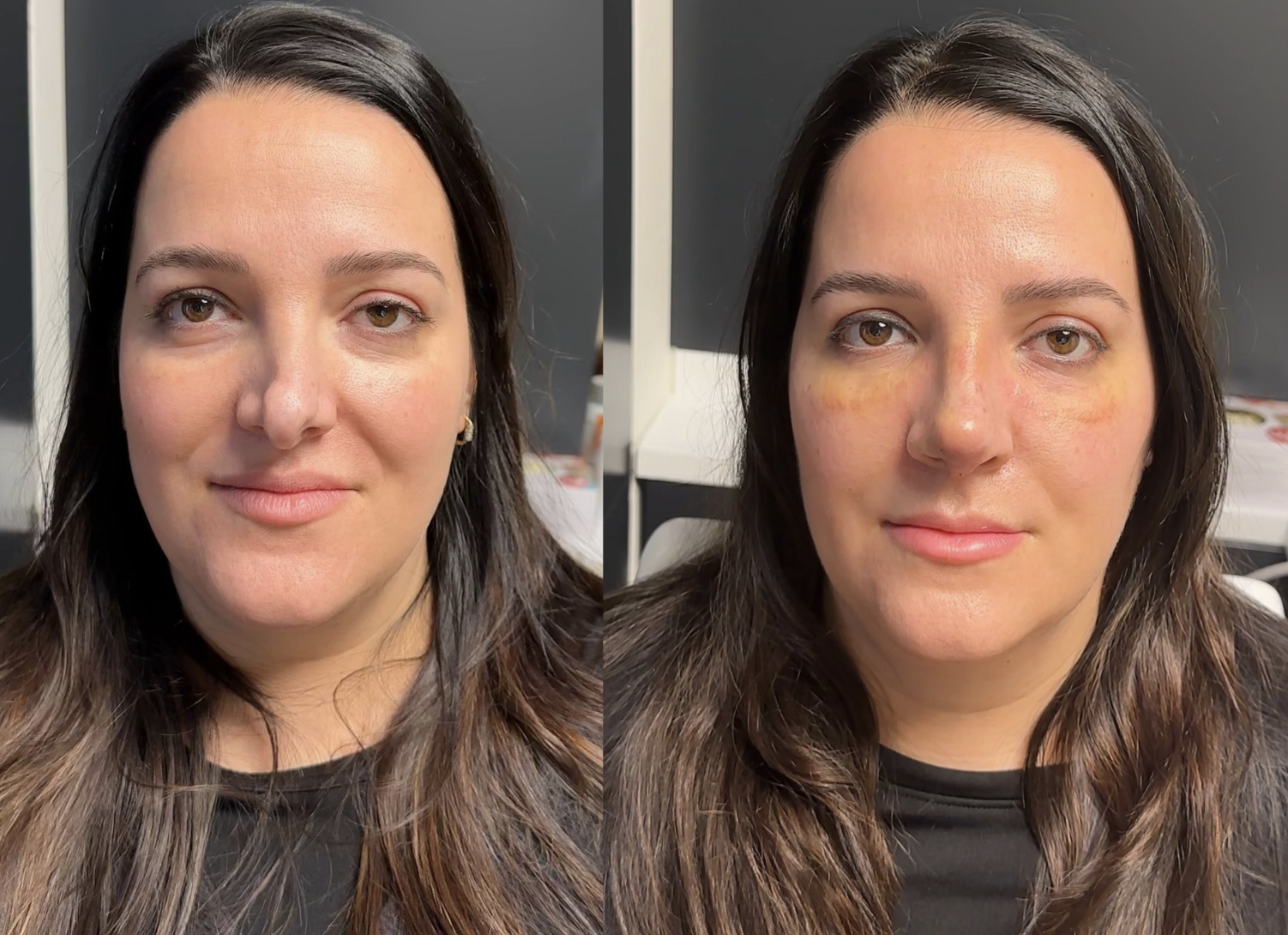 Natural primary rhinoplasty planning