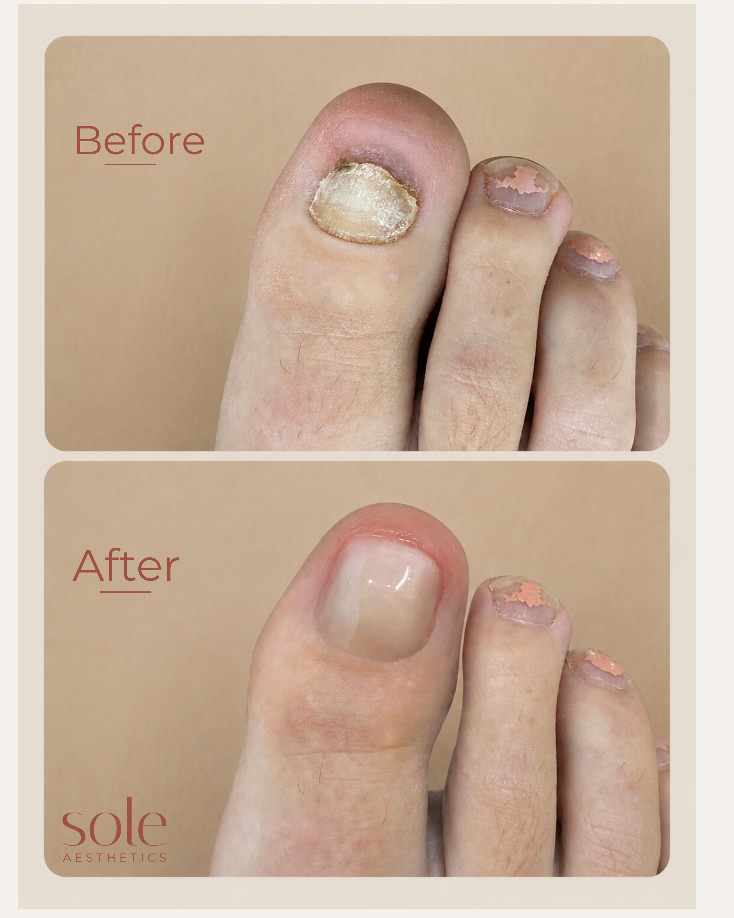 Comparison of a toenail before and after a cosmetic treatment, showing unhealthy, discolored, and damaged nails above, and healthy, clear, and well-manicured nails below.