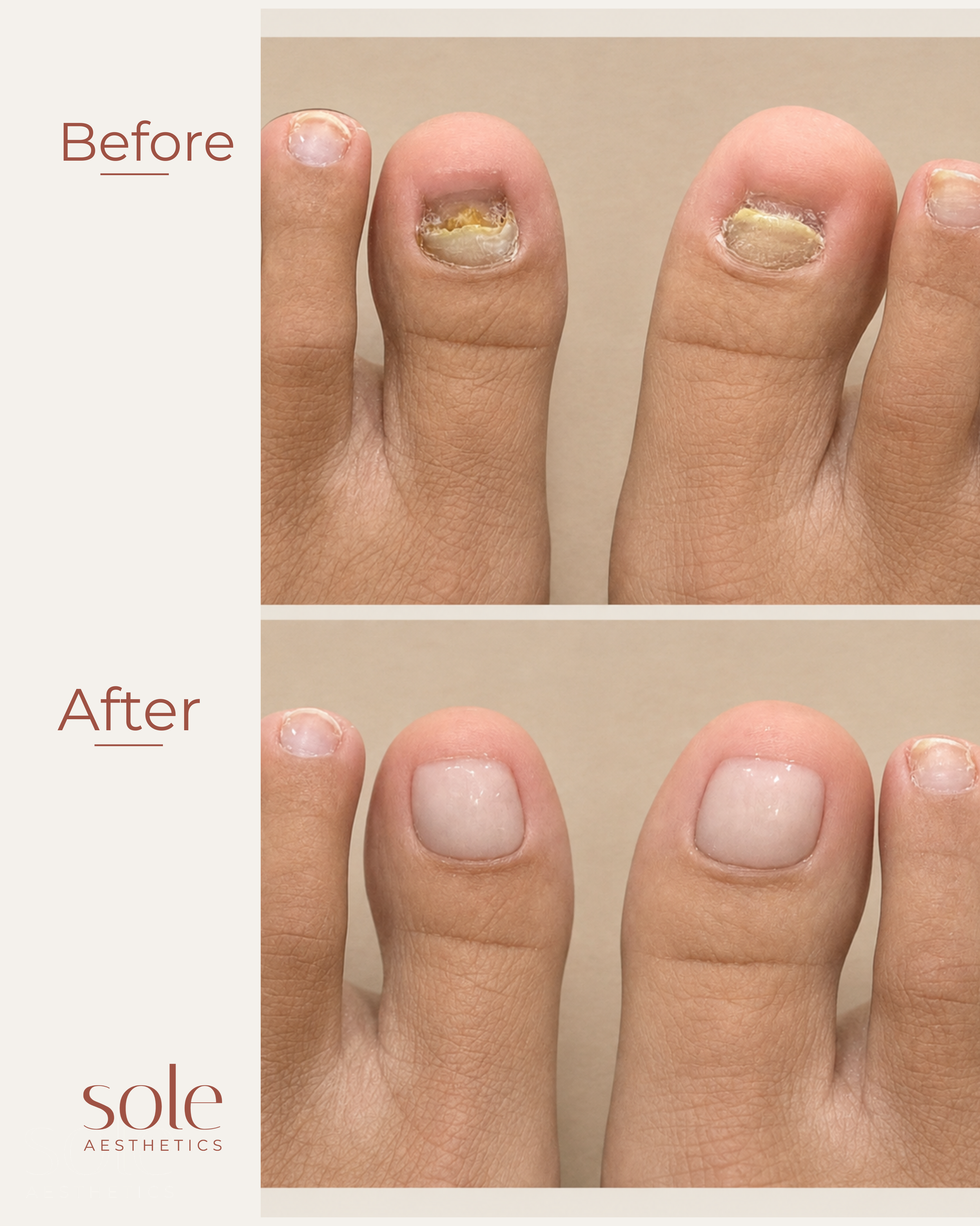 Before and after KeryFlex nail repair at Sole Aesthetics. Damaged, discoloured toenail restored to a healthy, natural appearance by a podiatrist in Prahran, Melbourne.