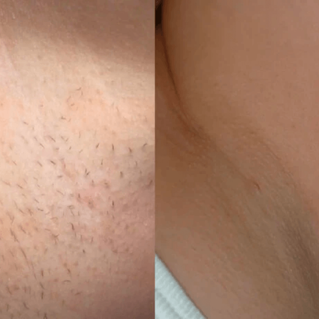 Anti-Wrinkles