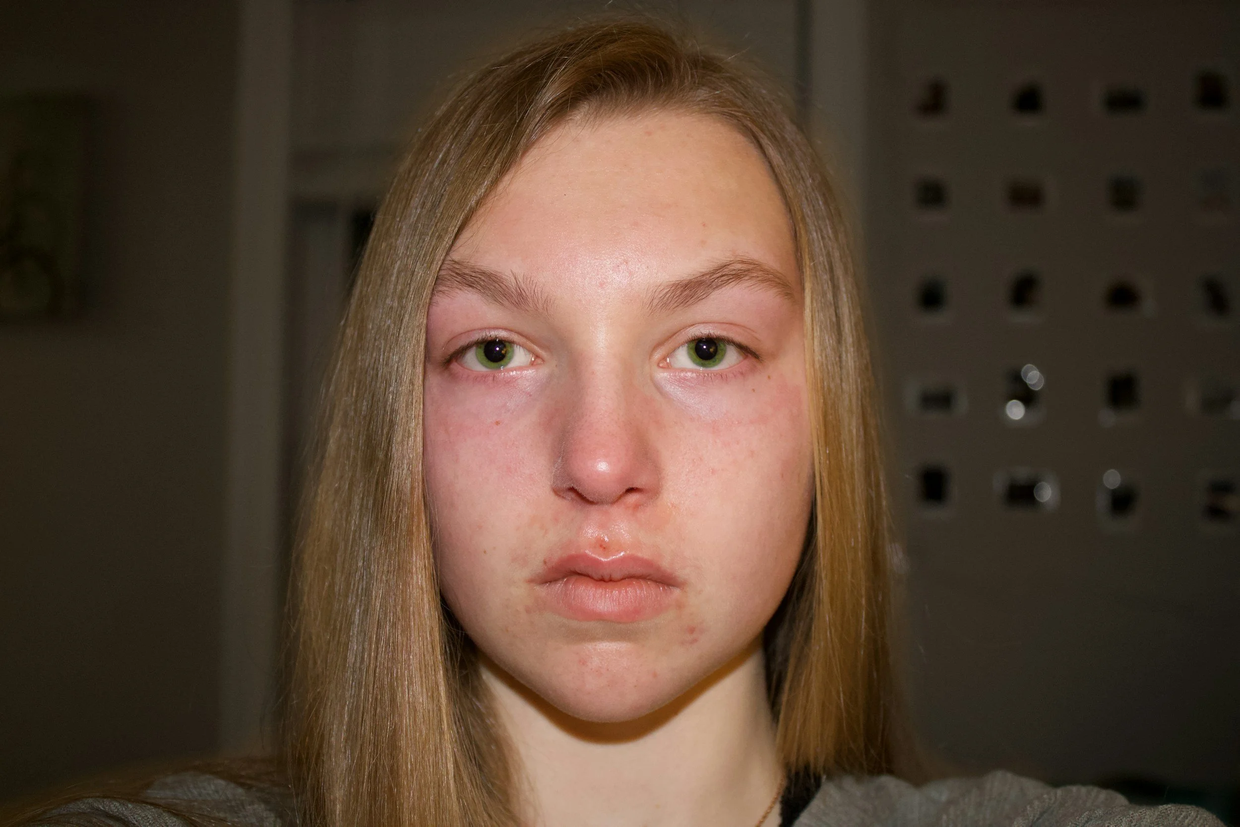 Lower Face & Jawline Softening