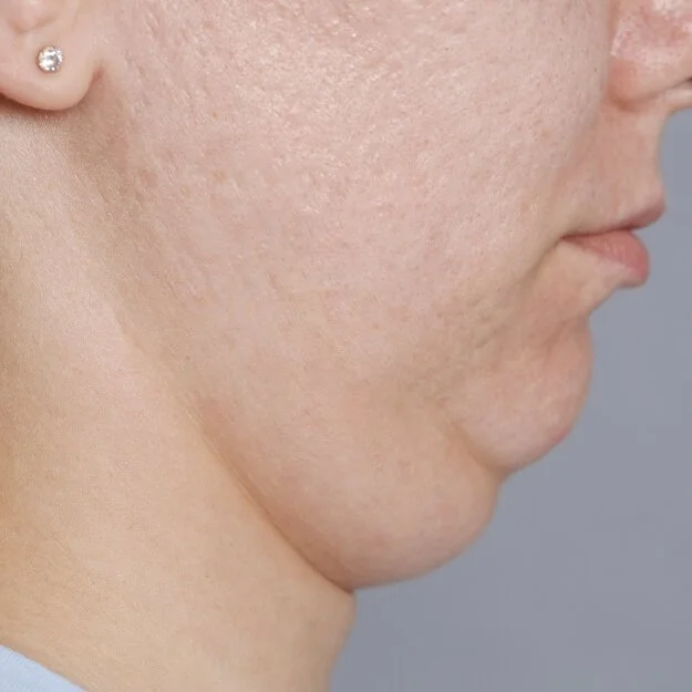 Submental & Double Chin Fat