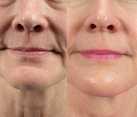 Wrinkles