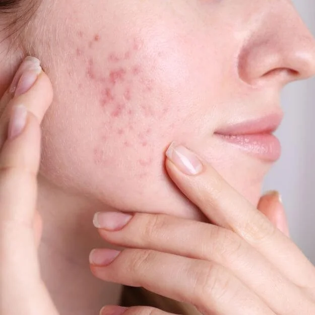 Acne Scarring & Pitting