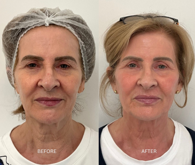 Anti-Wrinkles