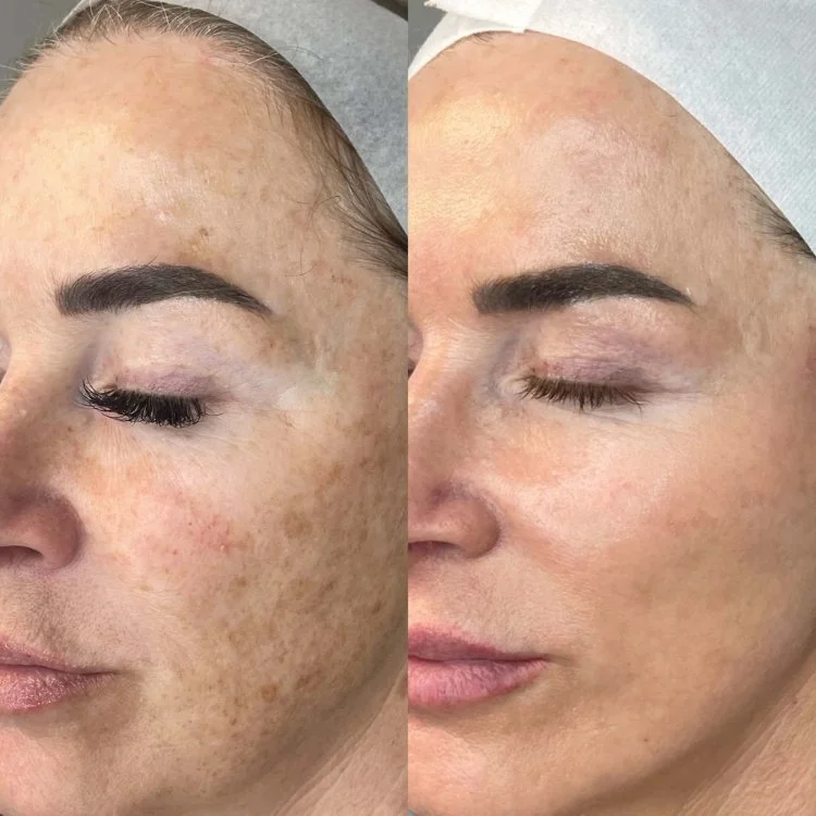 Anti-Wrinkles