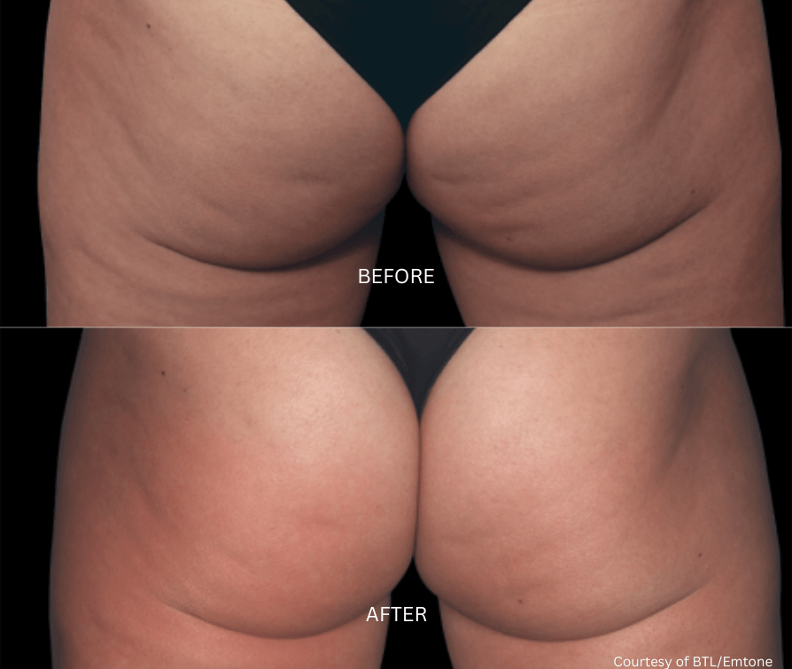 Body Transformation
