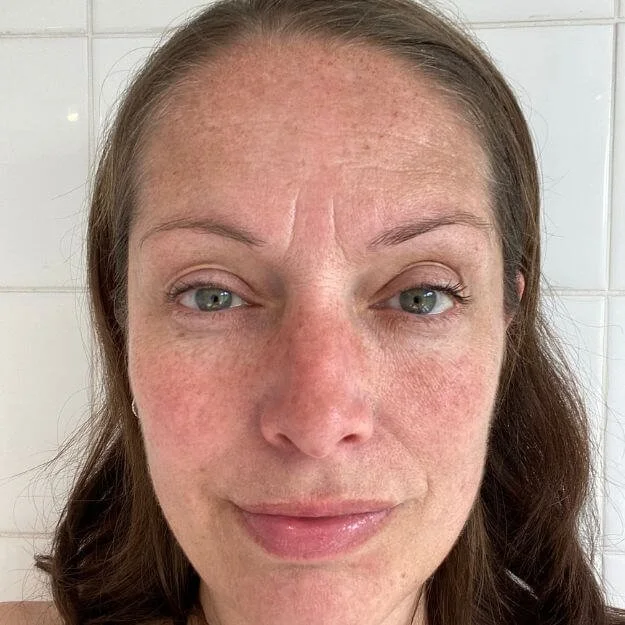 Sun Damage & Solar Lentigines: