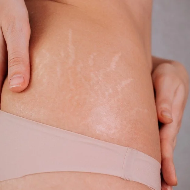 Stretch Mark Revision