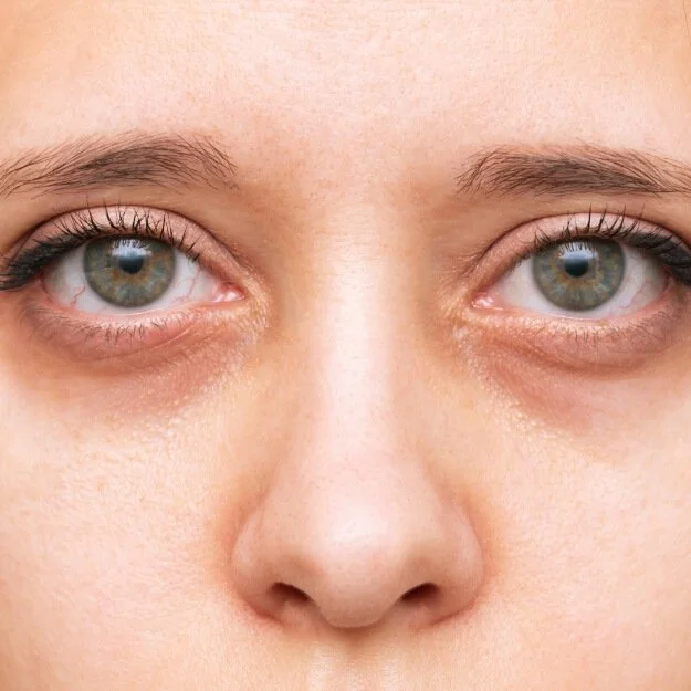 Infraorbital Volume Depletion