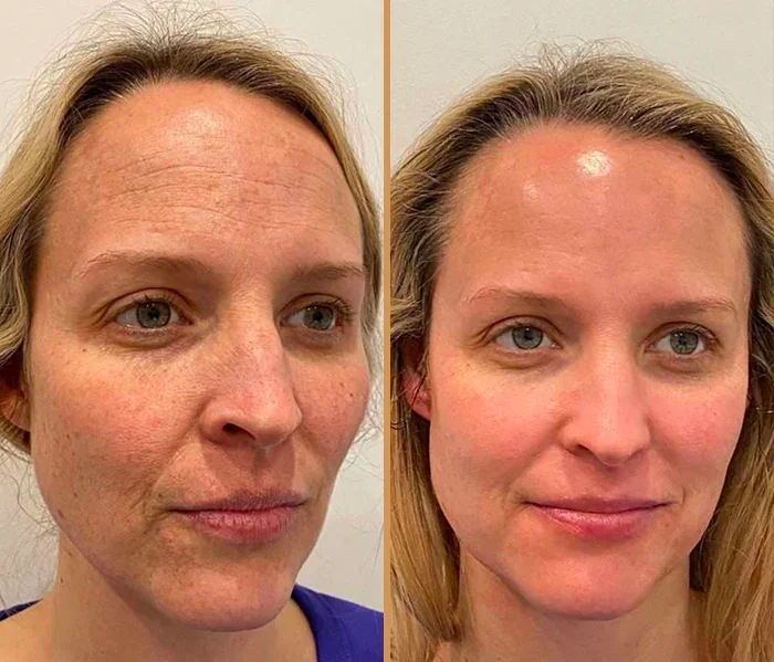 Anti-Wrinkles