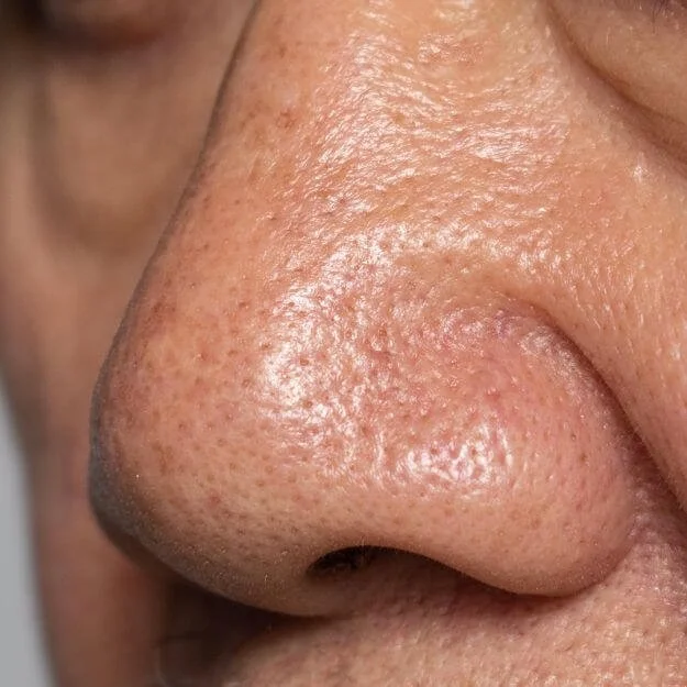 Coarse & Uneven Texture