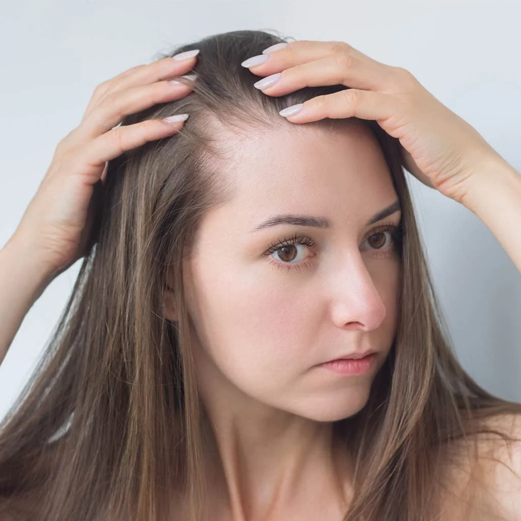 Diffuse Scalp Shedding