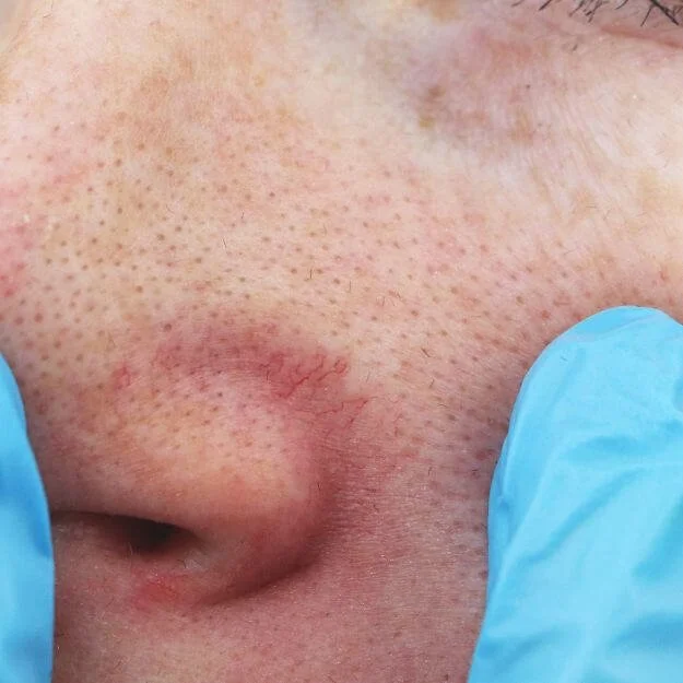 Facial Telangiectasia & Thread Veins
