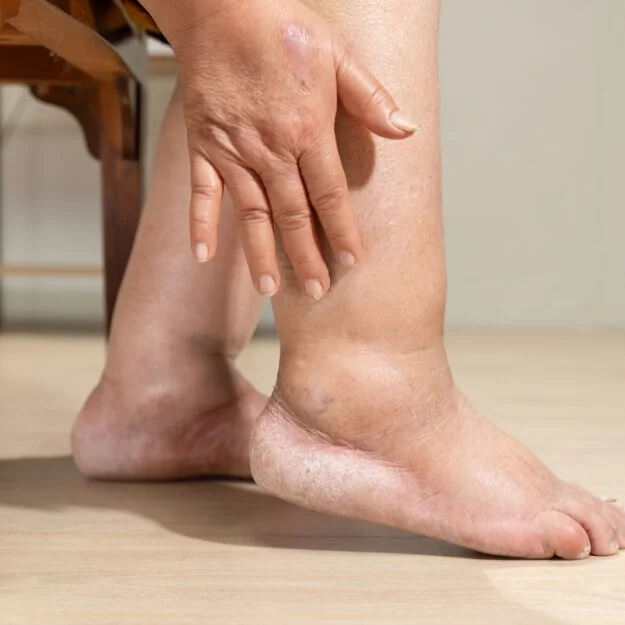 Post-Treatment or Post-Surgical Swelling