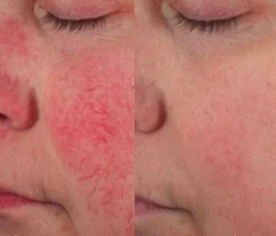 Anti-Wrinkles