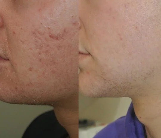 Anti-Wrinkles