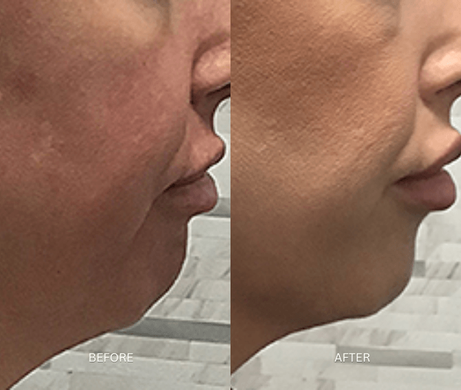 Anti-Wrinkles