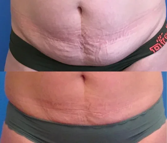 Body Transformation