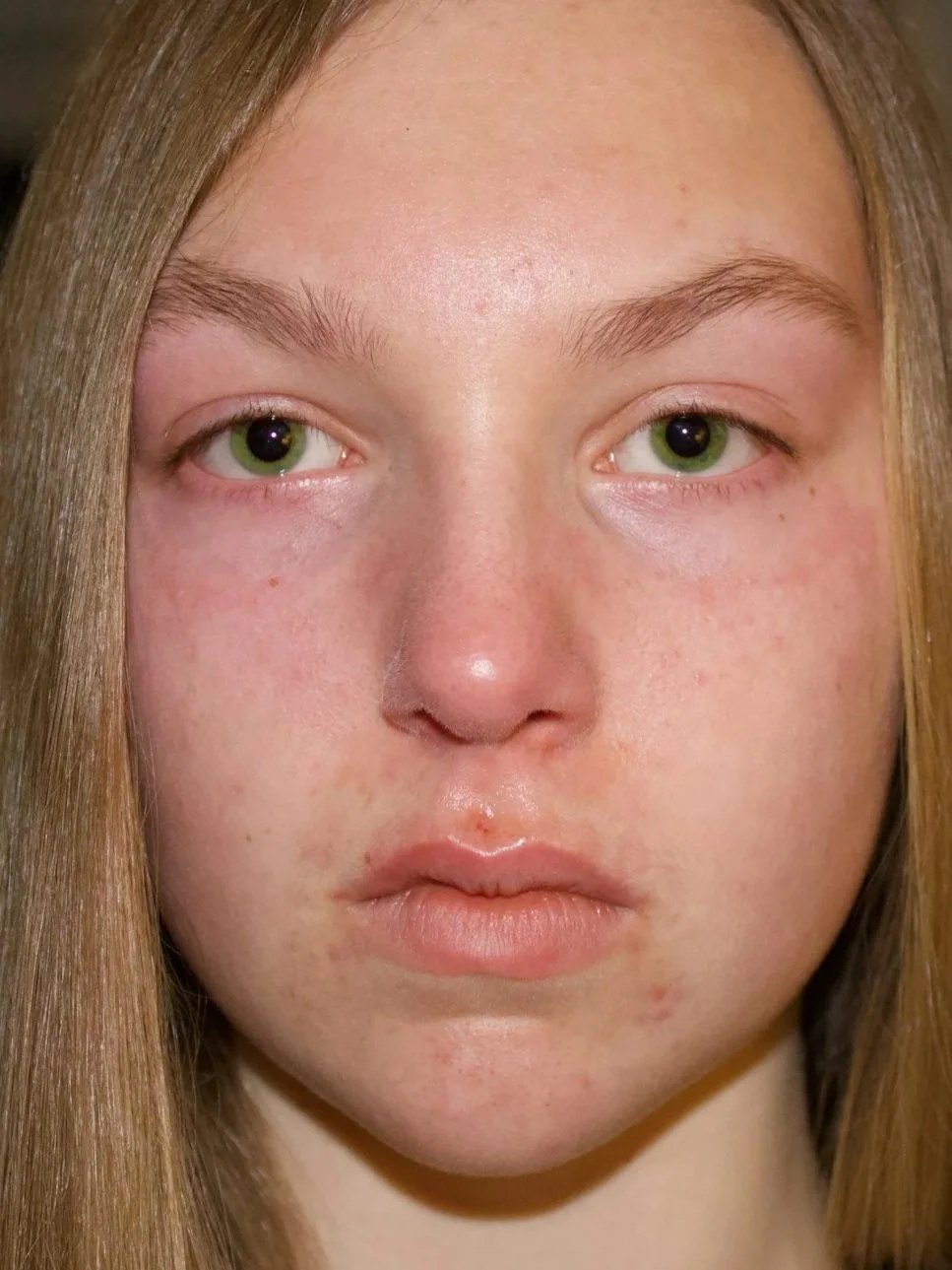 Diffuse Facial Flushing